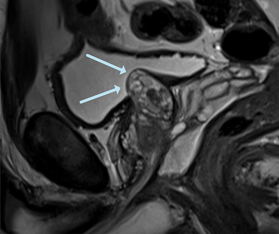 Medianlobe Newarrows