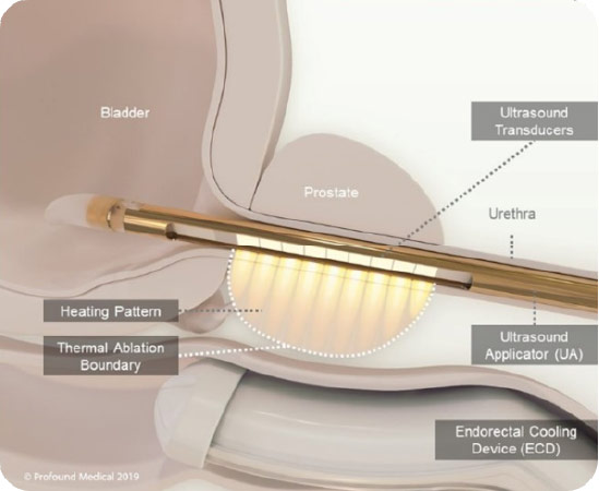 Tulsa Prostate Diagram