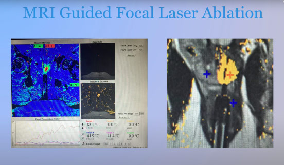 Mri Guided Focal Laser Ablation