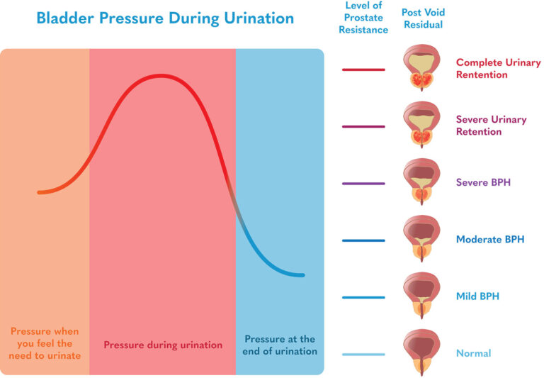 Bladder pressure during urination and prostate resistance chart