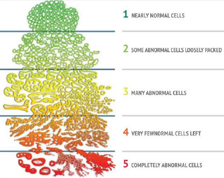 Gleason Score Prostate Cell Diagram.jpg