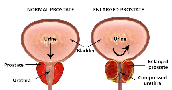 Normal vs enlarged prostate