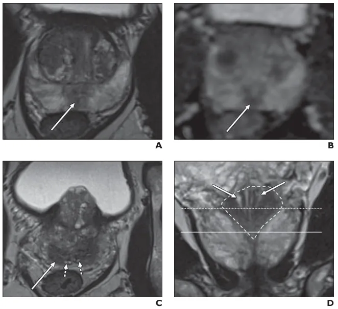 The appearance of the central zone of the prostate can mimic the appearance of prostate cancer.