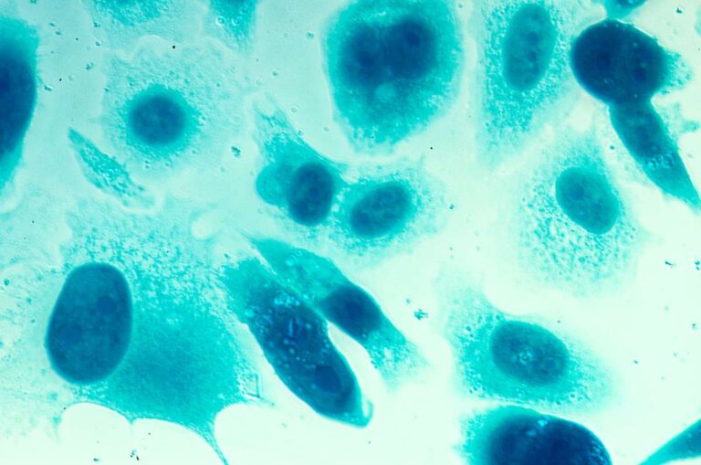 Prostate cancer cells stained and viewed under a microscope.