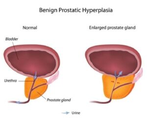 An Illustration Compares A Normal Sized Prostate And Enlarged Prostate