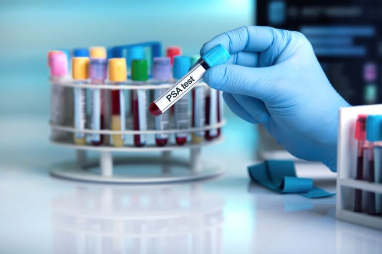 A gloved hand holds a blood vial marked “PSA Test” in a lab.