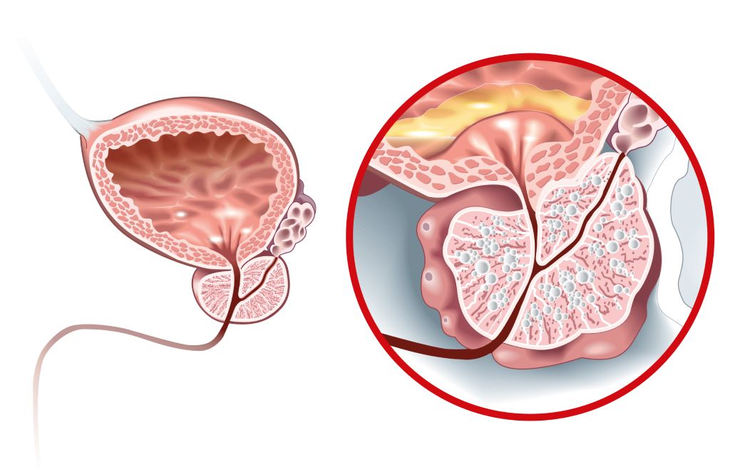 An illustration shows a healthy prostate and an enlarged prostate.