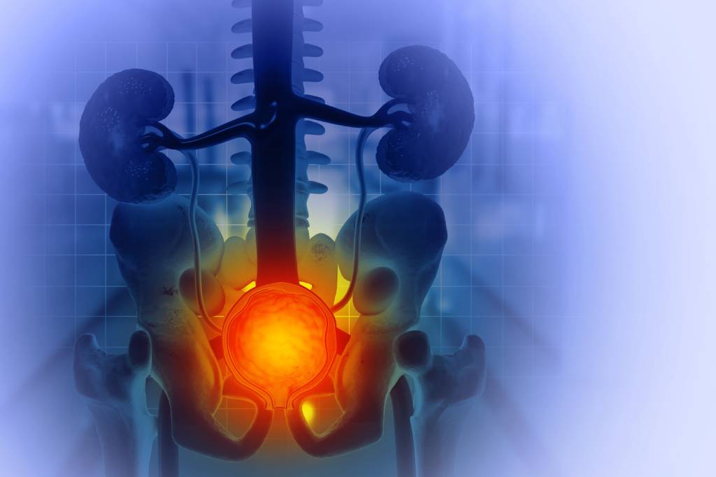 A graphic showing an enlarged prostate and its position relative to the skeleton.