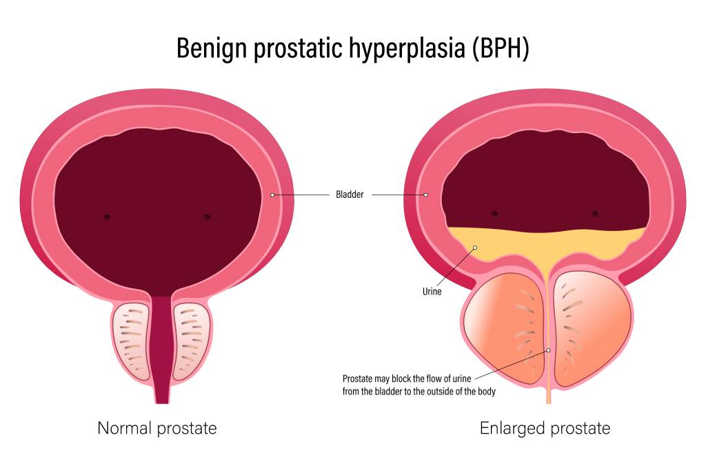 A medical illustration shows a normal and enlarged prostate.