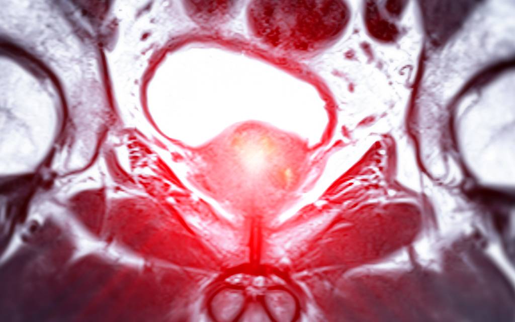An MRI image of a prostate.