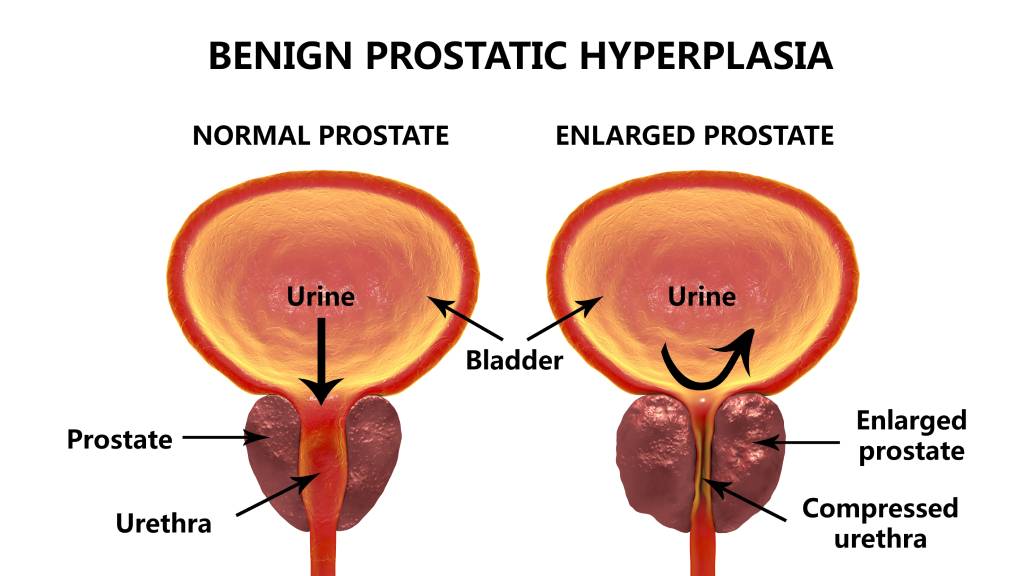 An illustration compares a normal prostate to an enlarged prostate.