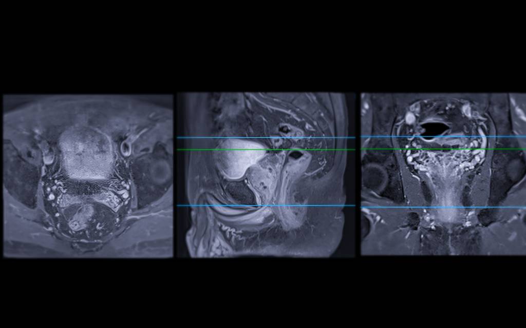 MRI images showing an enlarged prostate.