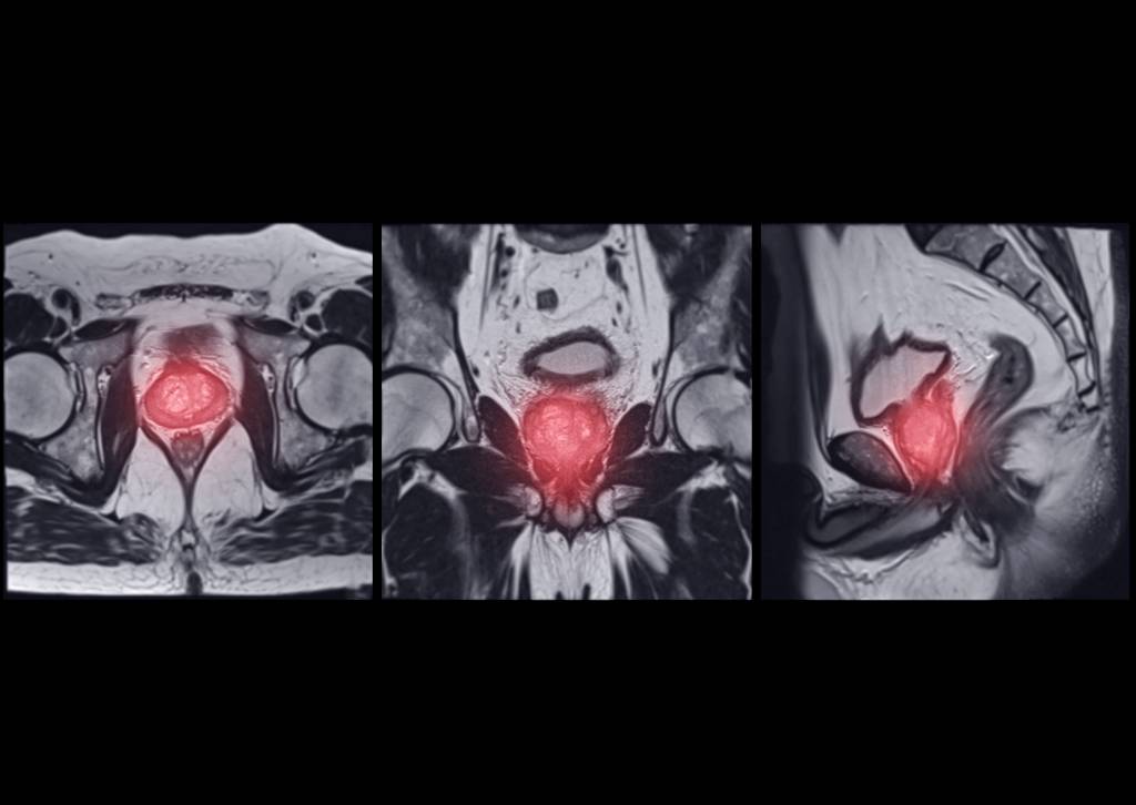 MRI images showing the prostate gland highlighted in red.